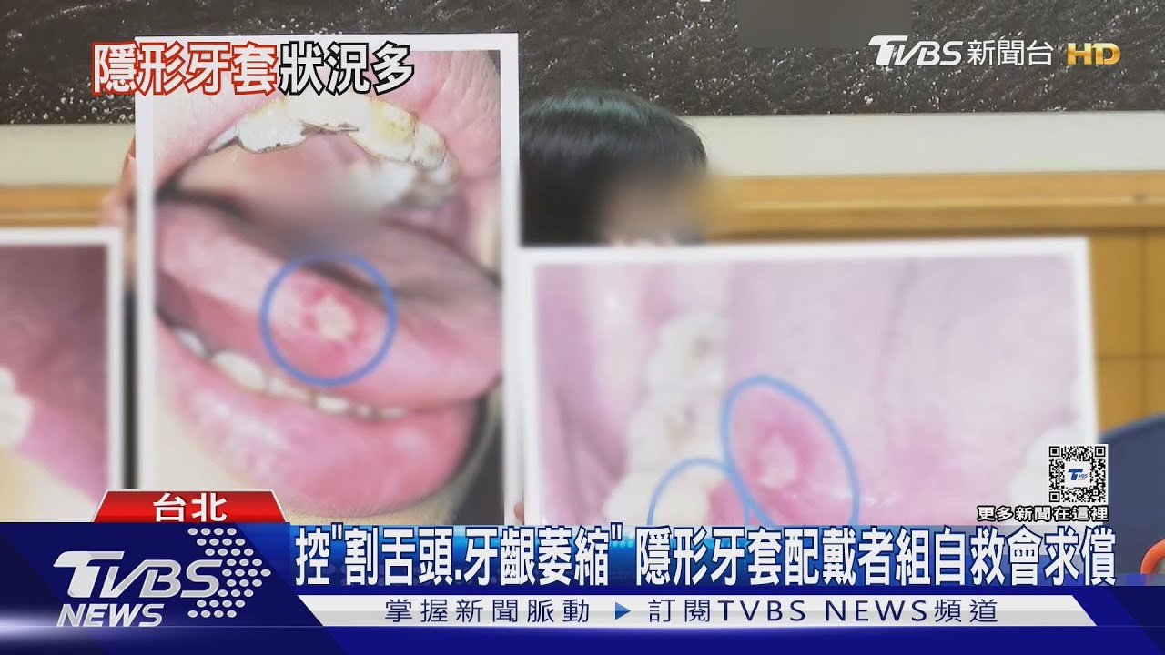 控「割舌頭、牙齦萎縮」!隱形牙套配戴者組自救會求償