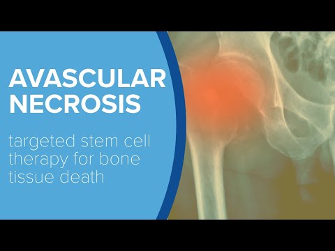 Treating Avascular Necrosis with Stem Cells - Yale Medicine Explains