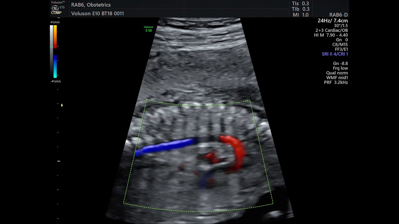AORTA FETAL