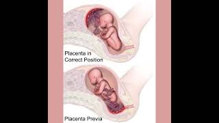 Podcast 740: Placenta Previa