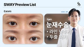EYES PREVIEW. 소시지쌍꺼풀 바뀔 수 있나요? | #눈재수술 #라인낮추기 #두줄따기