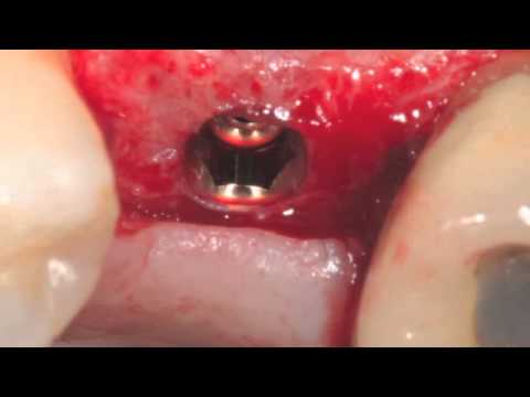 Nova técnica para a remoção de implantes dentários com problemas