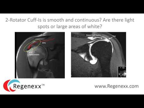How to read your shoulder MRI with Dr. Centeno of Regenexx