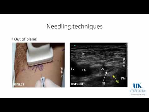 20160328 PNB : Common Upper Extremity Blocks