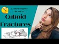 Answering your questions about....Cuboid Fractures