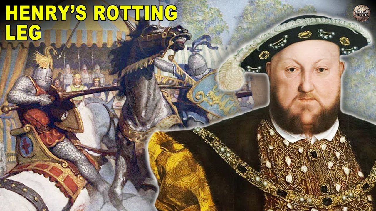 The total lot You Didn't Want To Know About Henry VIII's Ulcerated Leg 