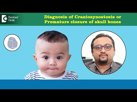 Early closure of head bones or joints in Babies |Craniosynostosis- Dr.Vybhav Deraje| Doctors' Circle