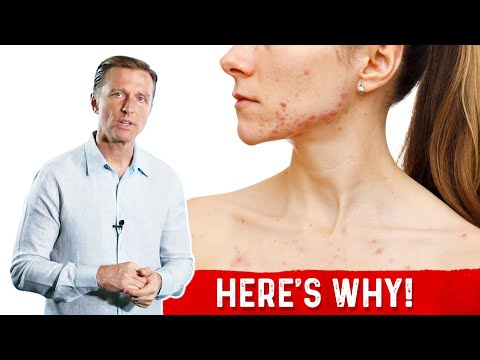 How To Fix Enlarged Prostate Explained By Dr Berg