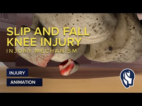 Slip and Fall Knee Injury Mechanism Animation