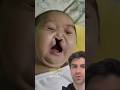 Baby With Cleft Lip