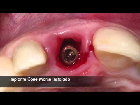 Instalação de implante imediato pós-extração dental em região estética