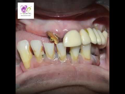 Replacing the missing tooth by best dentist in coimbatore