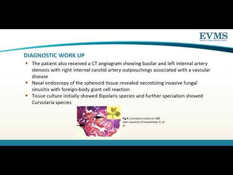 Thumbnail image of video presentation for Invasive Fungal Infection caused by Curvularia Species in a Patient with Intranasal Drug Use: A Case Report