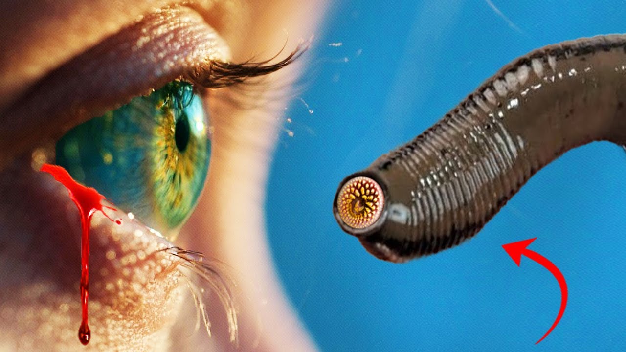 Что Если ПИЯВКА Присосется к ГЛАЗУ?