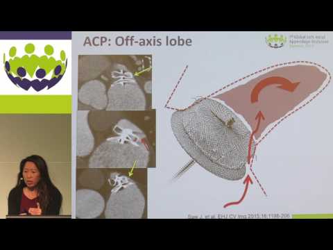 Jacqueline Saw - Assessment, implications and management of residual leaks after LAA occlusi