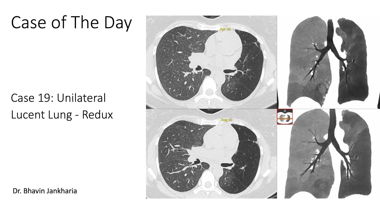 Case of the Day - 019 - 2025 04 16  - Unilateral Lucent Lung  - Redux