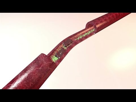 New Cholesterol Treatments