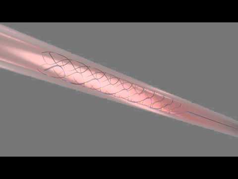 Stimulating the brain without major surgery