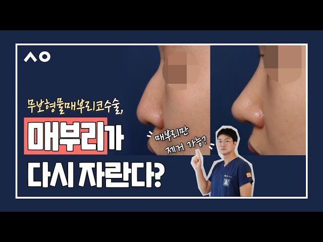눈·코·재수술은 시우성형외과 눈·코·재수술은 시우성형외과