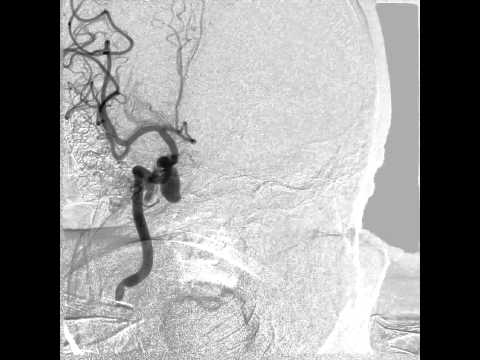 Fistula ani (végbélnyílás-sipoly) műtéte