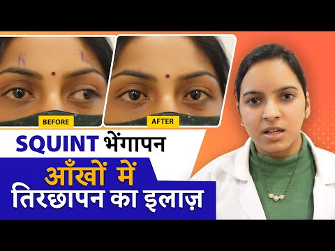 SQUINT Treatment || आँखों के भैंगापन  का इलाज