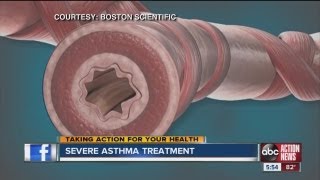 Non-drug procedure helps severe asthma patients breathe easier