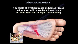 Plantar Fibromatosis - Everything You Need To Know - Dr. Nabil Ebraheim