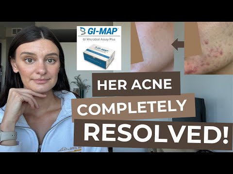 Reviewing GI-MAP Stool Test Results and Treatment Plan for My Acne Patient | ACNE CSE REVIEW