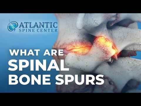 What Are Spinal Bone Spurs? | Spinal Osteophytes
