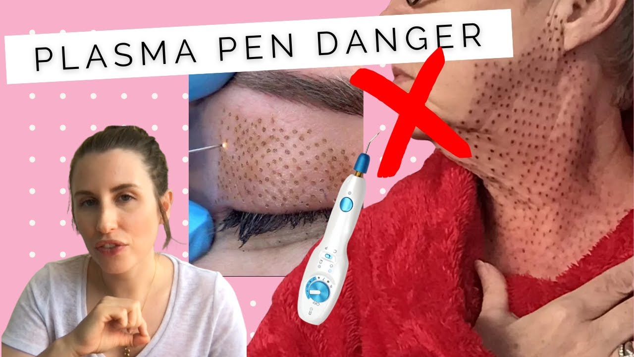 The Dangers Of PLASMA FIBROBLAST TREATMENT | Scarring, Hyperpigmentation and Poor Outcomes