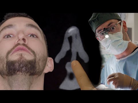 Signs You Have a Deviated Septum