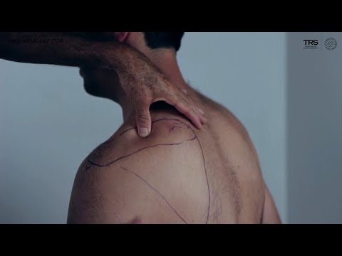 Supraspinatus Trigger Point Release