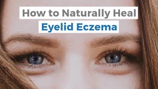 How to Naturally Heal Eyelid Eczema | Itchy Eyelid Remedies