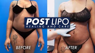 Post Liposuction Healing and Care