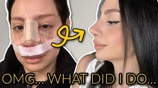 LITTLE OVER 3 MONTHS NOSE JOB POST OP