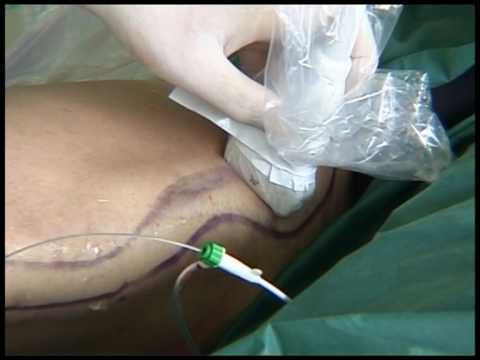 L'occlusione laser endovenosa (EVLO) con Venex di KLS Martin (parte 2)