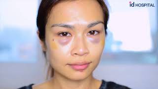 My Plastic Surgery Experience in Korea Part 2 / ID Hospital