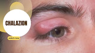 Chalazion (swollen eyelid)