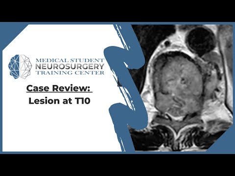 Case Review: Lesion at T10
