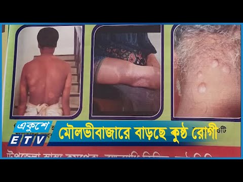 মৌলভীবাজারে প্রতিনিয়ত ধরা পড়ছে কুষ্ঠ রোগী