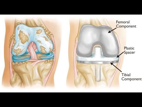 Total Knee Replacement, Dr. Sachin Karkamkar | Expert Robotic Joint Replacement Surgeon