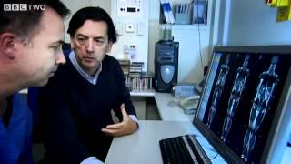 Jacques&#39; MRI Scan - The Men Who Made Us Fat - Episode 1 - BBC Two