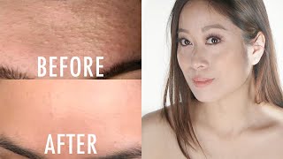 How To Get Rid of Whiteheads/Closed Comedones | Vivienne Fung