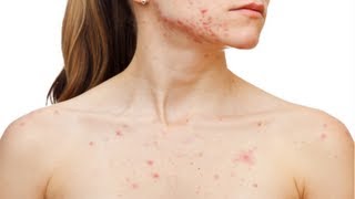 How to Get Rid of Acne Overnight -  Get Rid Of Acne Fast And Easy