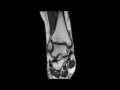 MRI of a normal ankle 