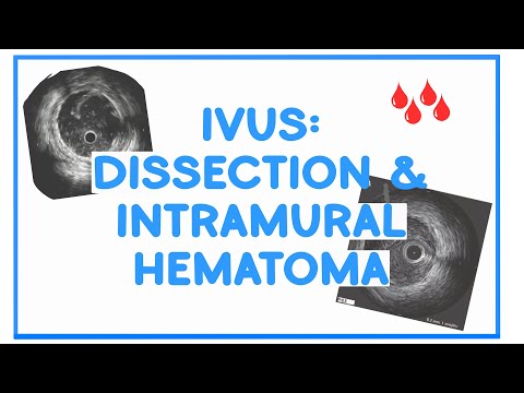 IVUS: Identify DISSECTION and intramural HEMATOMA