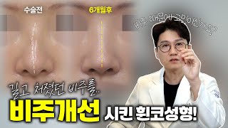 코필러 제거 후 휜코, 복코, 비주 길이 개선! 그리고 기능까지 해결한 여자 무보형물 코성형 6개월 경과