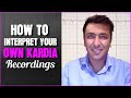 How To Interpret Your Own Kardia Recordings