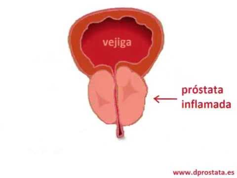 Hogyan lehet megszabadulni a prosztata adenomától
