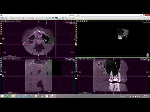 Sinus Volume Assessment   X Mind Trium